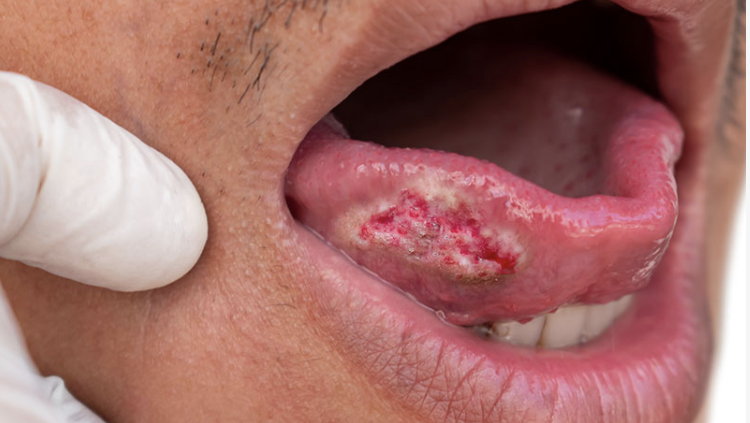 Oral cancer