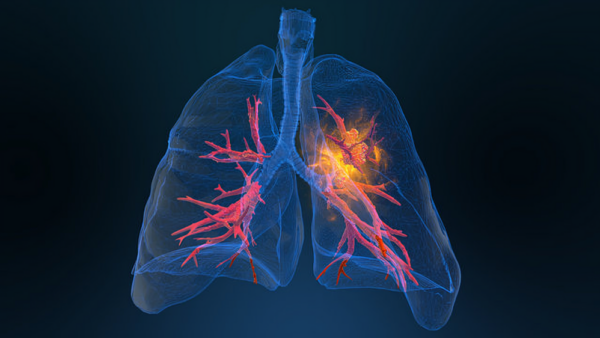 CT Scans