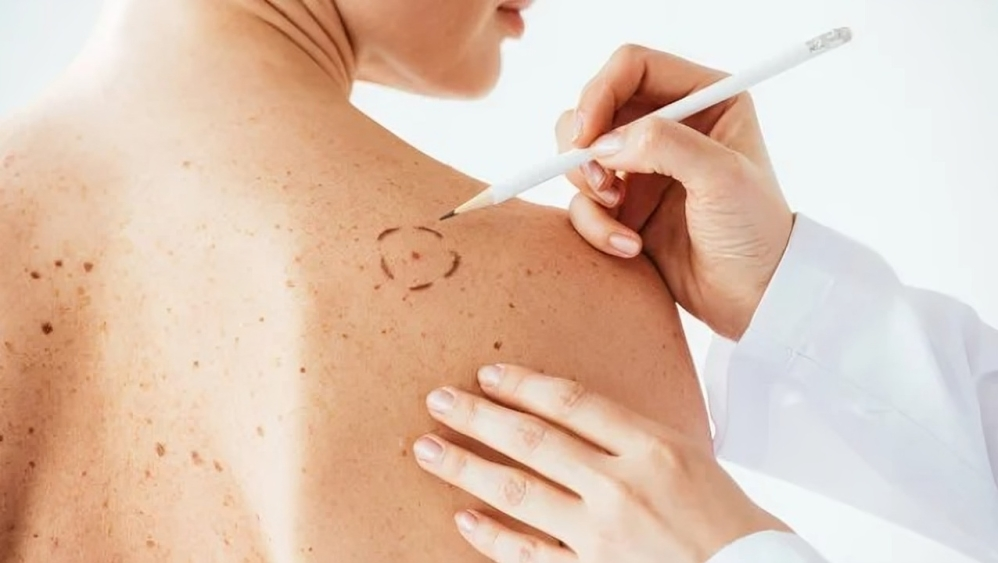 Melanoma Treatment