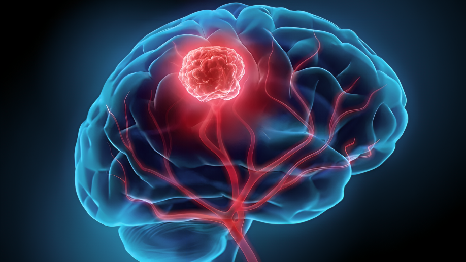 human brain metastases