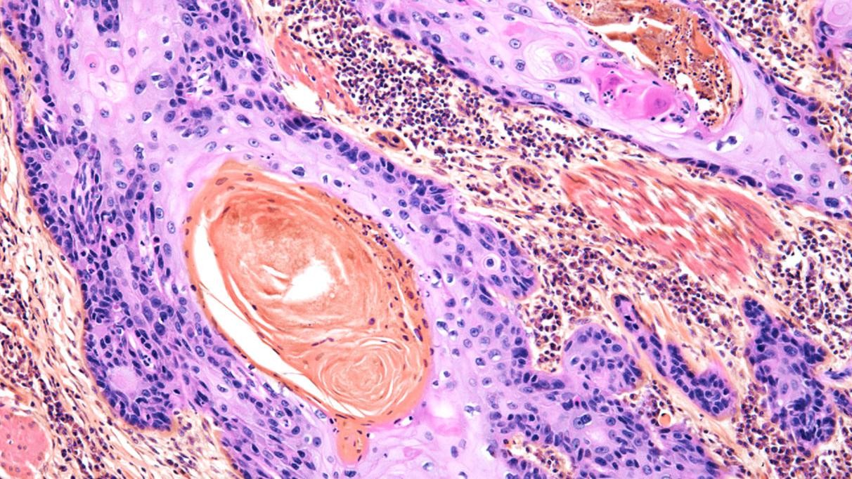 Melanoma