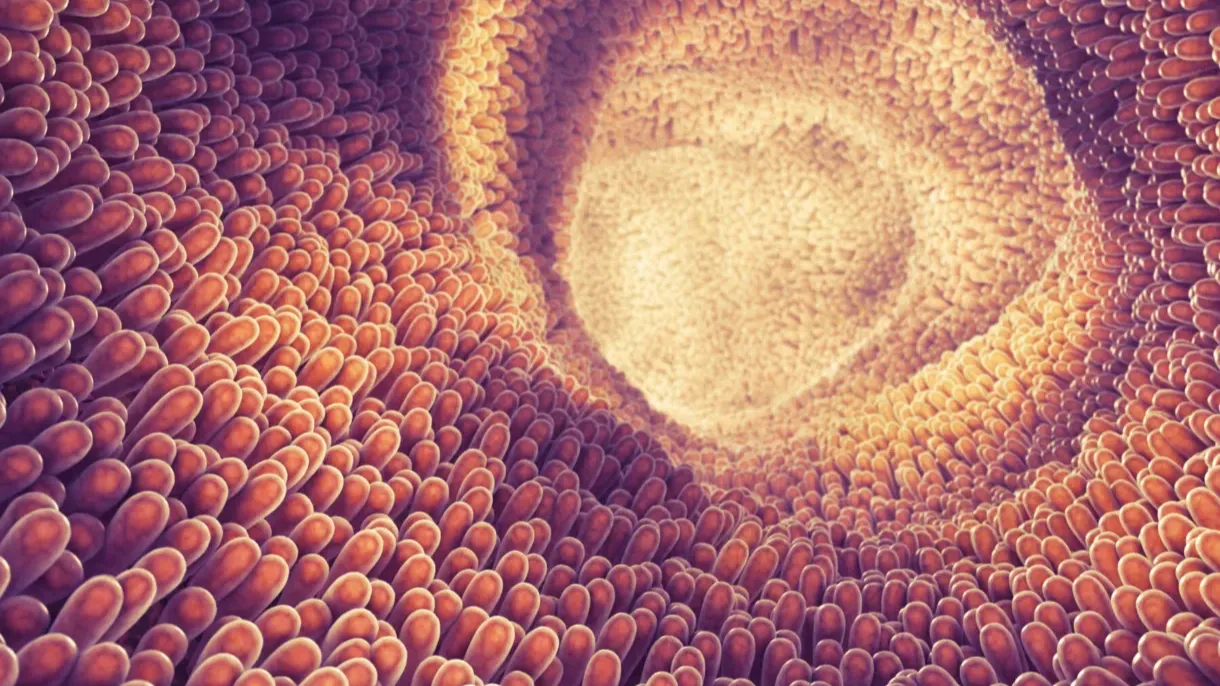 Bowel Cancer