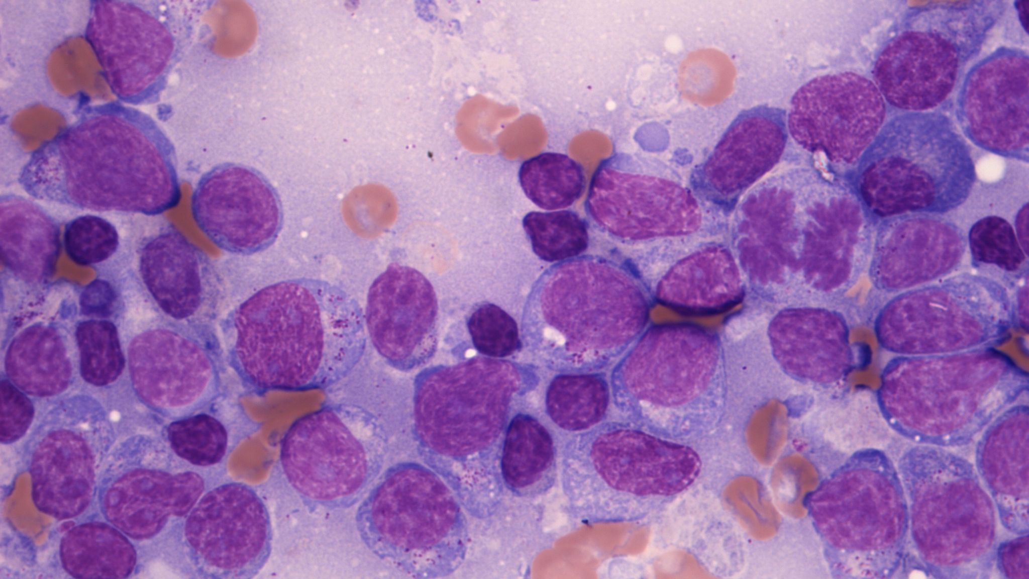 Blood Cancer