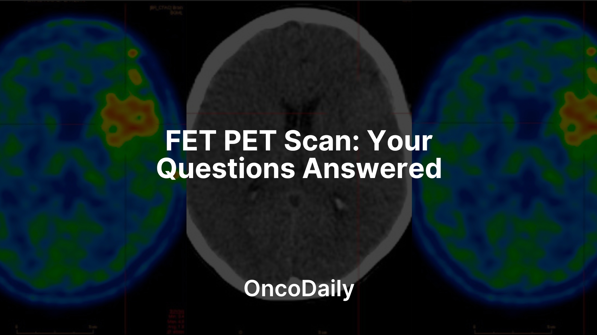 FET PET Scan-OncoDaily
