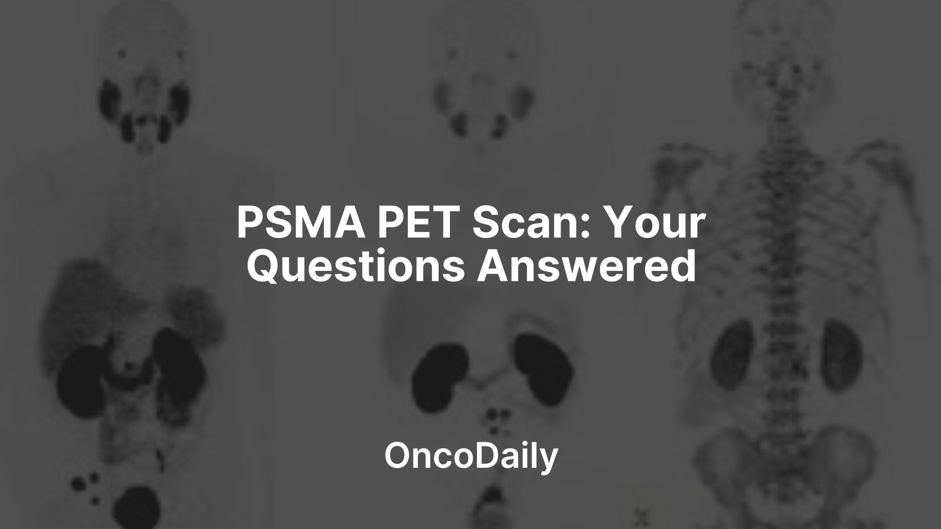 PSMA PET Scan-OncoDaily