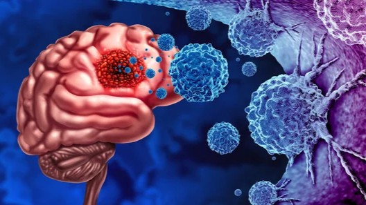 Glioma