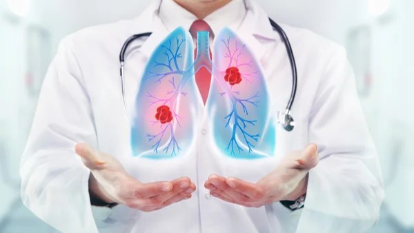 The Launch of Australia's National Lung Cancer Screening Program - Lung Cancer Policy Network