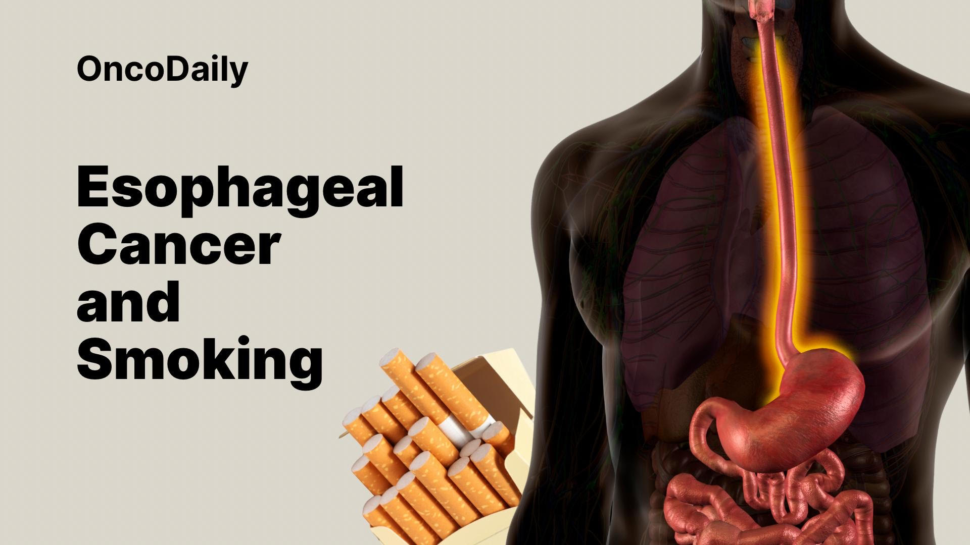 Esophagus Cancer and Smoking