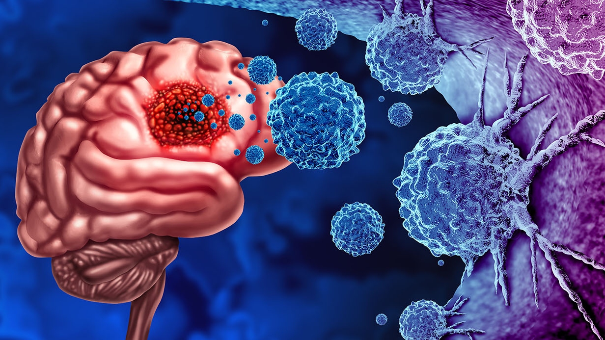Glioma